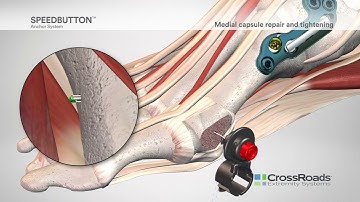 SpeedButton™ Extracortical Anchor for Medial Capsule and Plantar Approach to Plantar Plate Repair