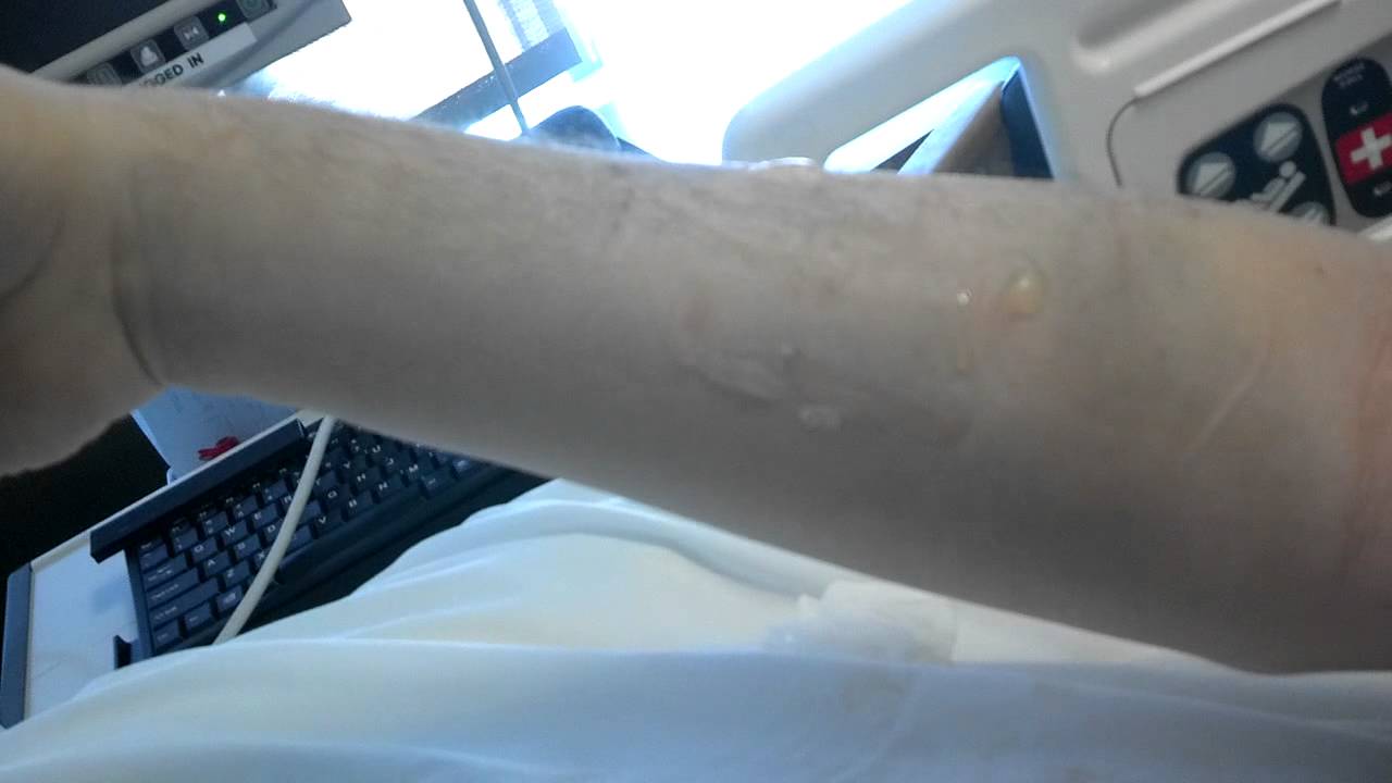 swollen from infiltration youtube