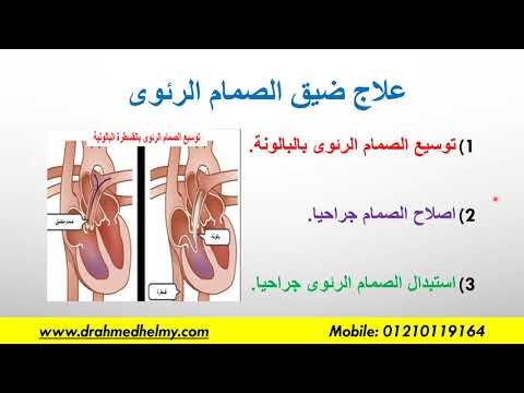 ضيق الصمام الرئوى. ماهو الصمام الرئوى وأسباب وأعراض الضيق وطرق العلاج المختلفة