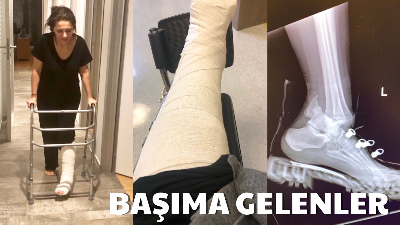 Ameliyat Oldum! Nasıl Düştüm? O Gün Neler Oldu? | İrem Güzey