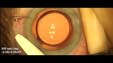 Toric IOL repositioning