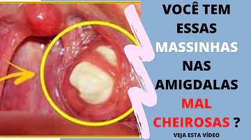 O que são bolinha amarelas na garganta?