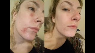 35% Glycolic Acid Peel BURN healing process