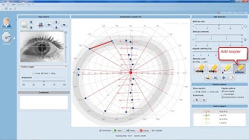 Tip Instructional – EyeSuite i9 Perimetry Performing a kinetic examination