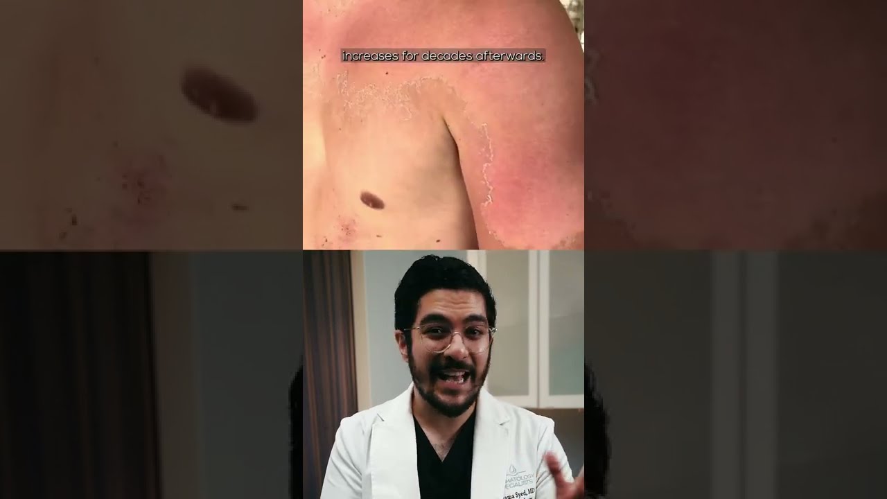 Dermatologist Reacts to a Severe Sunburn!