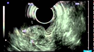 Type 1 Sphincter of Oddi Dysfunction due to Chronic Opium Addiction