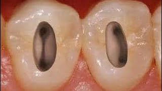 Access of upper first premolar demo شرح عربي مبسط