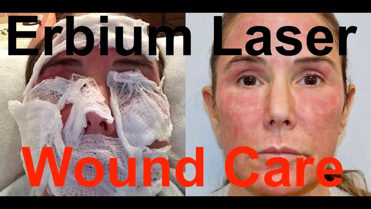 Action II Erbium Laser Resurfacing Wound Care ZO Post Procedure Action II Erbium Laser Resurfacing Wound Care ZO Post Procedure