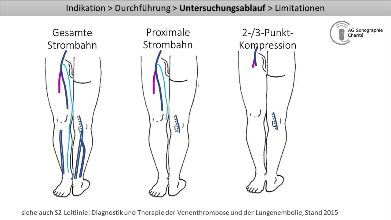 Kompressionssonographie der Beinvenen - Ausschluss einer tiefen Venenthrombose (TVT-Auschluss)