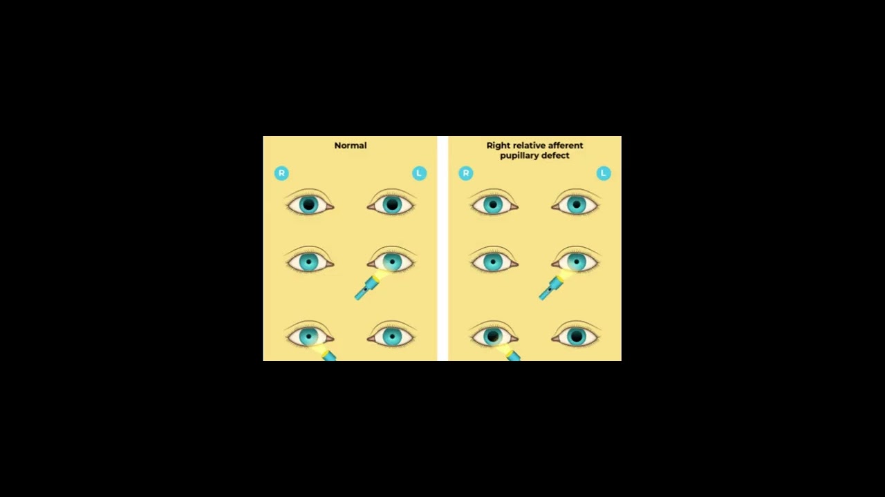 q26-28 Exploring the Macus gunn pupil and the RAPD - YouTube