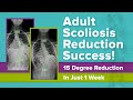 Adult Scoliosis Reduction Success! 15 Degree Reduction In Just 1 Week
