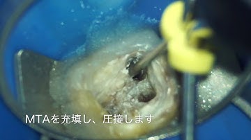 加圧MTA根管充填/南森町の歯医者・中長デンタルオフィス（なかちょう歯科）
