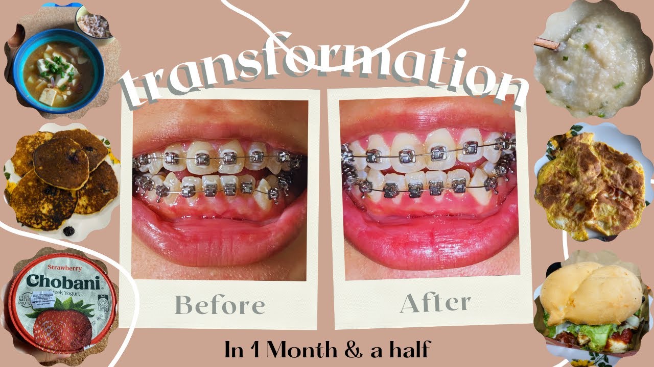 My Braces Journey! (Part 2) SelfLigating Braces Malaysia. Food I ate