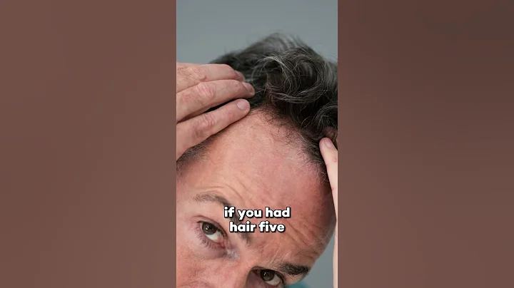BALDNESS REVERSED: EXPLORING THE CURE AND LIMITATIONS FOR REGROWTH - DayDayNews