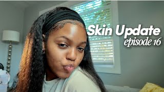 Mise À Jour De Skin Journey Épisode 16 Spf 50 Pour Peaux Grasses Et À Tendance Acnéique ? Ru...