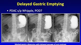 MDCT of Pancreatic Surgery: Normal Post-Op vs. Complications Part 2 screenshot 1