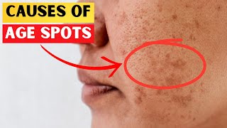 The #1 Deficiency Behind Aging Spots Revealed!