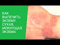 ★Как вылечить экзему. Сухая, мокнущая экзема