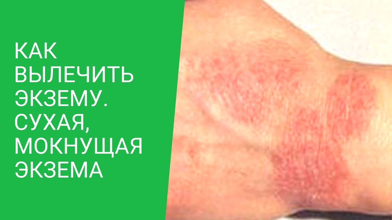 ★Как вылечить экзему. Сухая, мокнущая экзема - YouTube