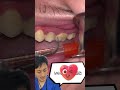 歯科医👨‍⚕と一緒に歯石🦷動画見よう！✨ #歯医者 #歯科医師 #金歯先生 #shorts #歯石除去