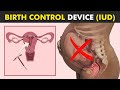 How Intrauterine devices (IUDs) Works To Control Birth?