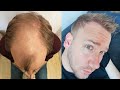 Hair transplant before and after  month by month results elithair 8