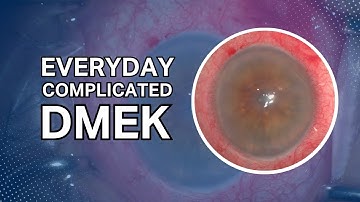Everyday Complicated DMEK – Advanced Tips