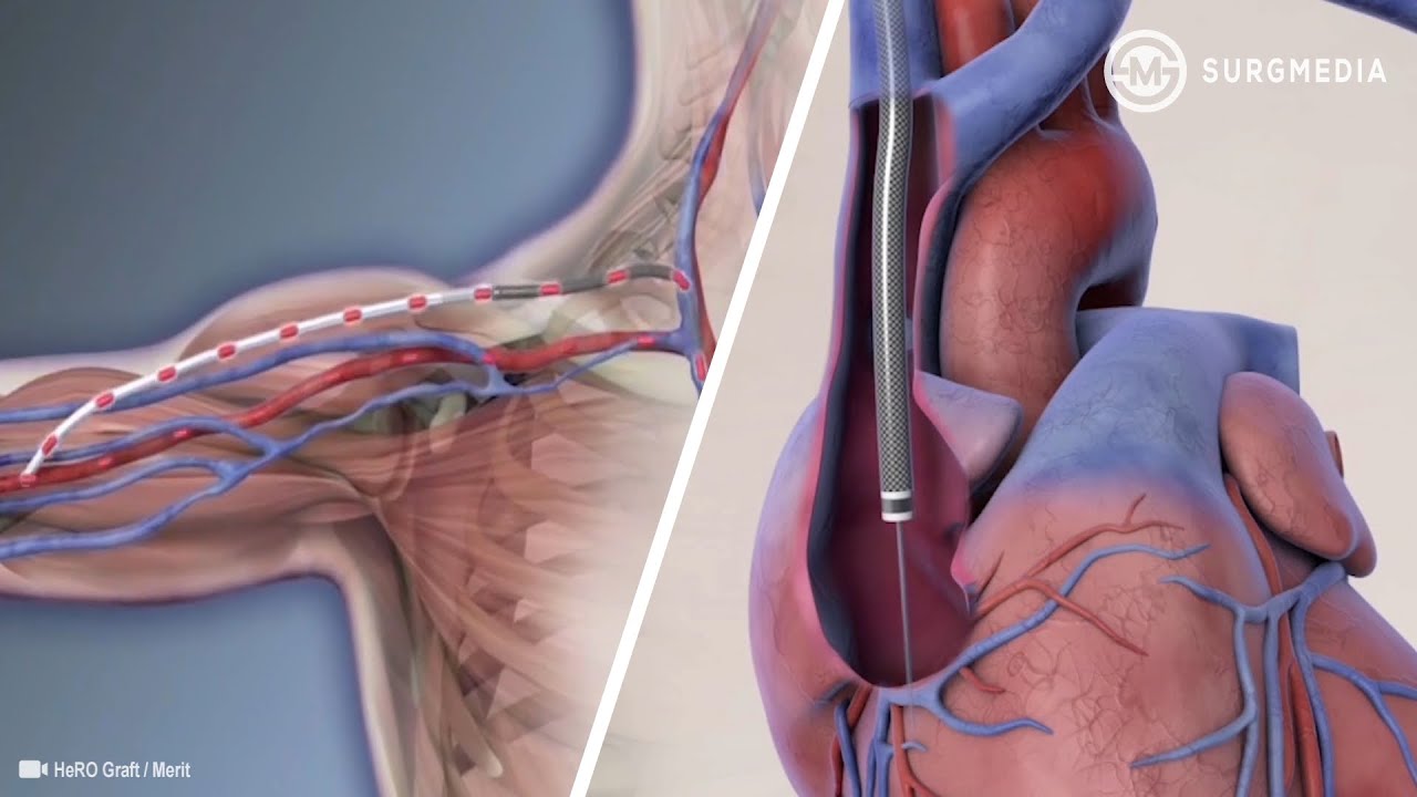 Long Term Access Solution for Hemodialysis Patients with Central Venous Stenosis