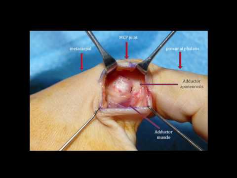 MEDICINE in a Nutshell: Injuries of the UCL of the thumb MCPJ