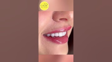 DÁN SỨ VENEER - NỤ CƯỜI TỎA SÁNG CÙNG NHA KHOA CALI LONG KHÁNH