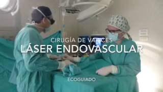 Laser endovascular Dr. Valderrama