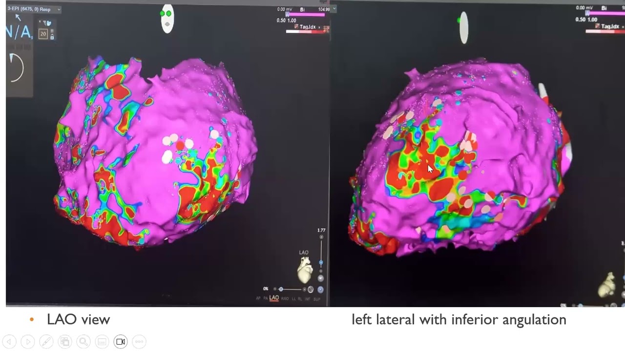 VT IN NON ISCHEMIC CARDIOMYOPATHY Dr, JOHN KAMEL ZARIF, MD