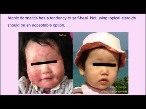 Atopic dermatitis managed without topical corticosteroids – Video Abstract [ID 109946]