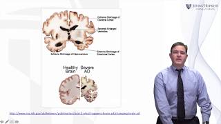 Alzheimer’s Disease: A Brief History - Living with Dementia by JHU #3