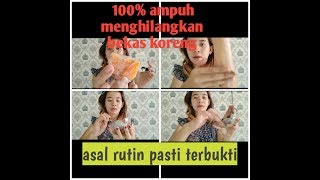 Cara menghilangkan bekas koreng