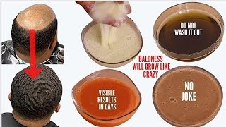 Most Potent Hair Growth mix😱 Use Daily to grow back alopecia baldness faster Only 3 ingredients