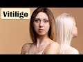 Vitiligo  causes pathogenesis signs  symptoms and treatment