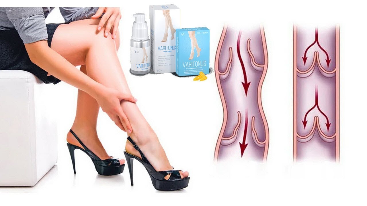 Жжение в ногах причины у женщин лечение. Варикозное расширение вен. Варикозное расширение вен нижних конечностей.