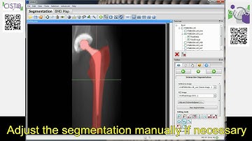 GIMIAS workflow computing the Bone Mineral Density map of a femur.
