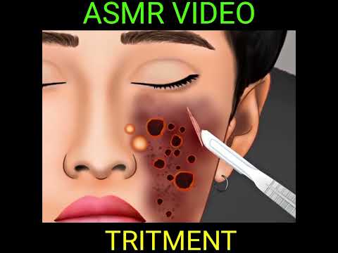 ASMR Treatment of