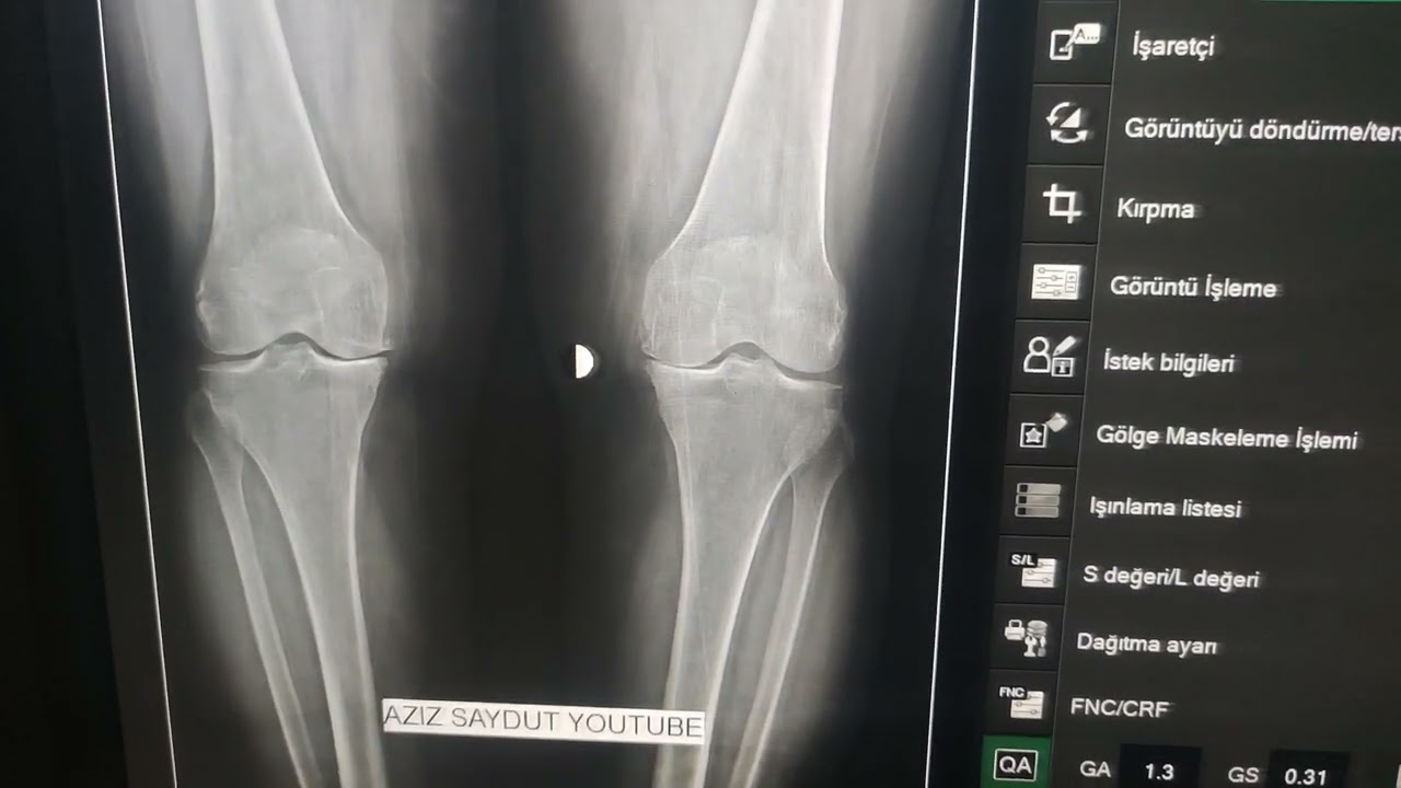 Diz Grafik Radyoloji Anatomik anlatım. Kenn