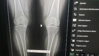 Diz Grafik Radyoloji Anatomik Anlatım. Kenn