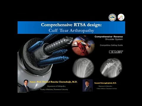 ComprehensiveRTSAReverseShoulderArthroplastyข้อไหล่เทียมชนิดกลับด้านข้อไหล่เสื่อมหลังเอ็นไหล่ฉีก