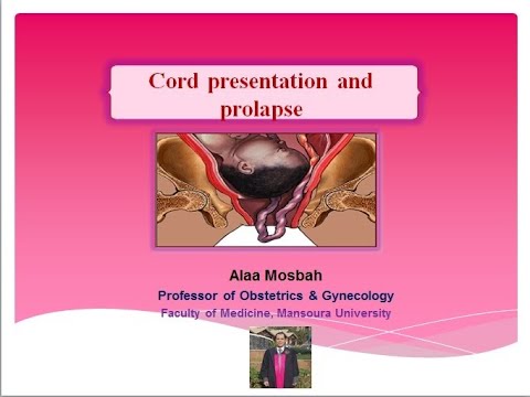 what are the types of cord presentation