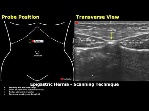 Image of Epigastric Hernia Ultrasound Probe Positioning & Scanning Technique 