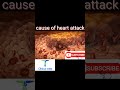 cause of heart attack ❤️❤️#shorts #youtubeshorts #mbbs #clinical #heartattack