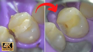 Tooth Cavity Removal | Repairing Tooth Decay with dental filling by Smile Influencers 9,876 views 1 year ago 3 minutes, 56 seconds