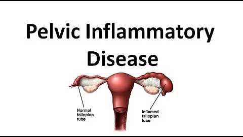 Pelvic Inflammatory Disease (PID) - DayDayNews