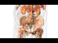 3D Aortic Occlusion