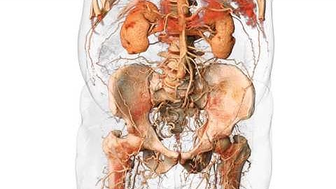 3D Aortic Occlusion